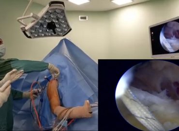 La lesione della cuffia dei rotatori, cioè dei tendini della spalla: patologia molto frequente, trattabile e guaribile